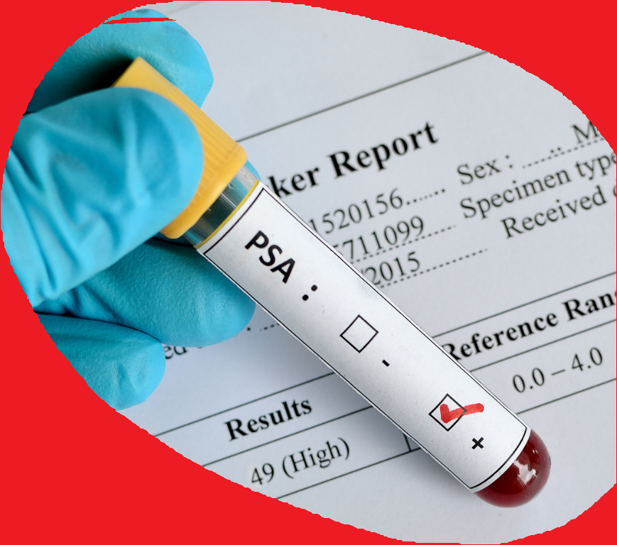 El antigeno prostatico, Importancia para el diagnostico temprano