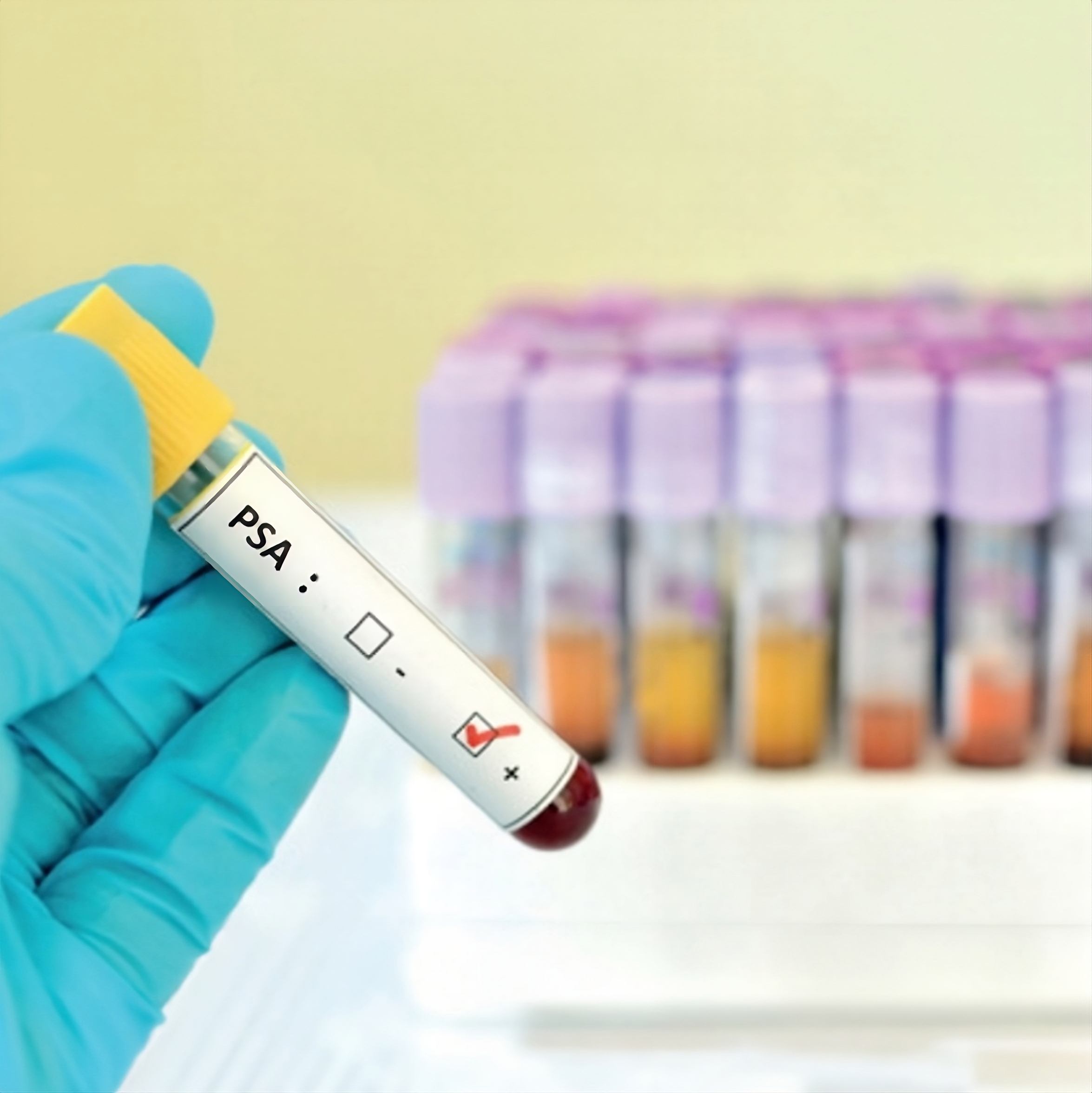 PSA total (Prostate Antigen)